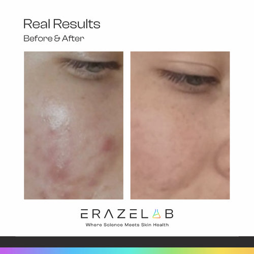 Eraze Trio - Your Clear Skin Starts Here