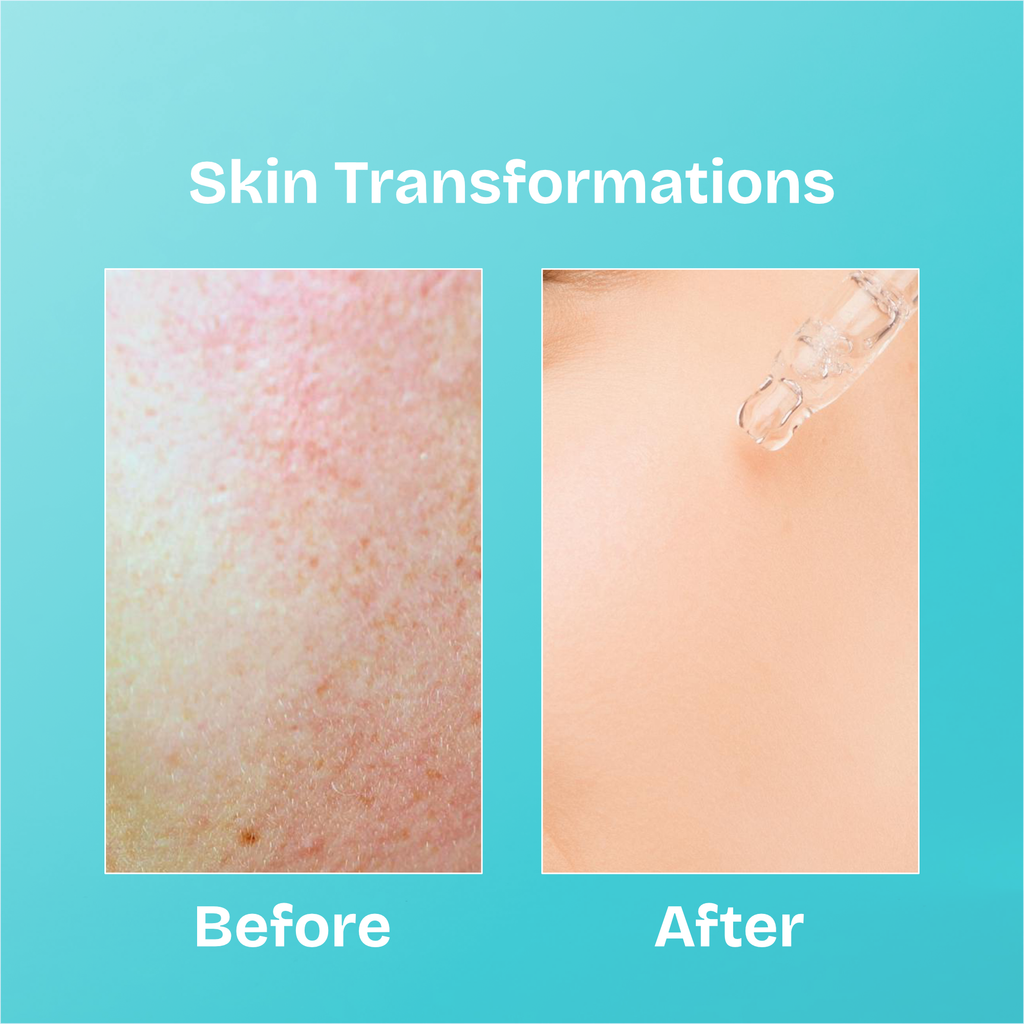 Erazer - Acne Control Lightweight Fluid